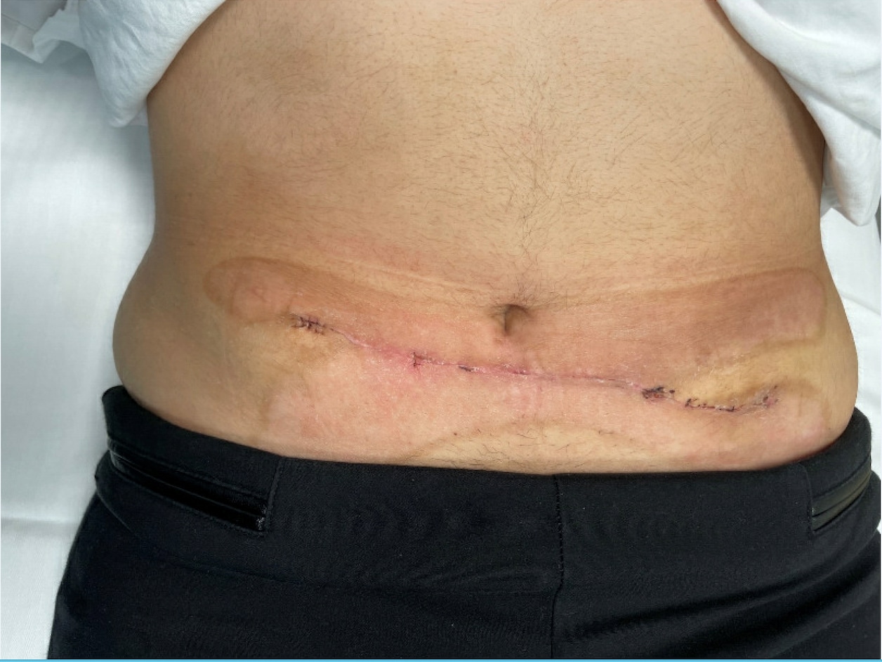 Fat Freezing Gone Wrong